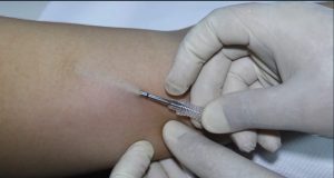 Panamá Norte promueve la salud femenina con la colocación de implantes subdérmicos