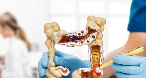 Impulsando la detección temprana del cáncer colorrectal: estudio panameño evalúa la prueba inmunoquímica fecal (FIT) como herramienta clave.