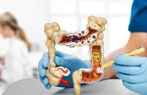 Impulsando la detección temprana del cáncer colorrectal: estudio panameño evalúa la prueba inmunoquímica fecal (FIT) como herramienta clave.