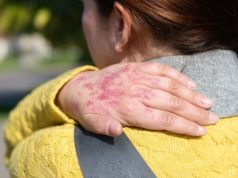 La Enfermedad Psoriásica y sus Comorbilidades: Un Efecto Dominó en la Salud