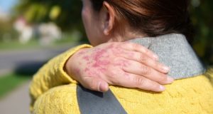 La Enfermedad Psoriásica y sus Comorbilidades: Un Efecto Dominó en la Salud