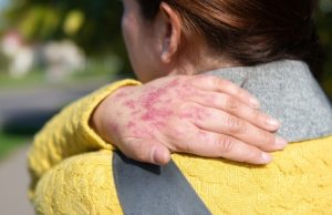 La Enfermedad Psoriásica y sus Comorbilidades: Un Efecto Dominó en la Salud